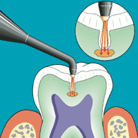 dente2