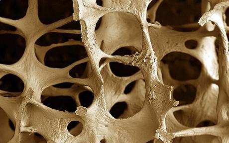 osteoporosi e malattia parodontale